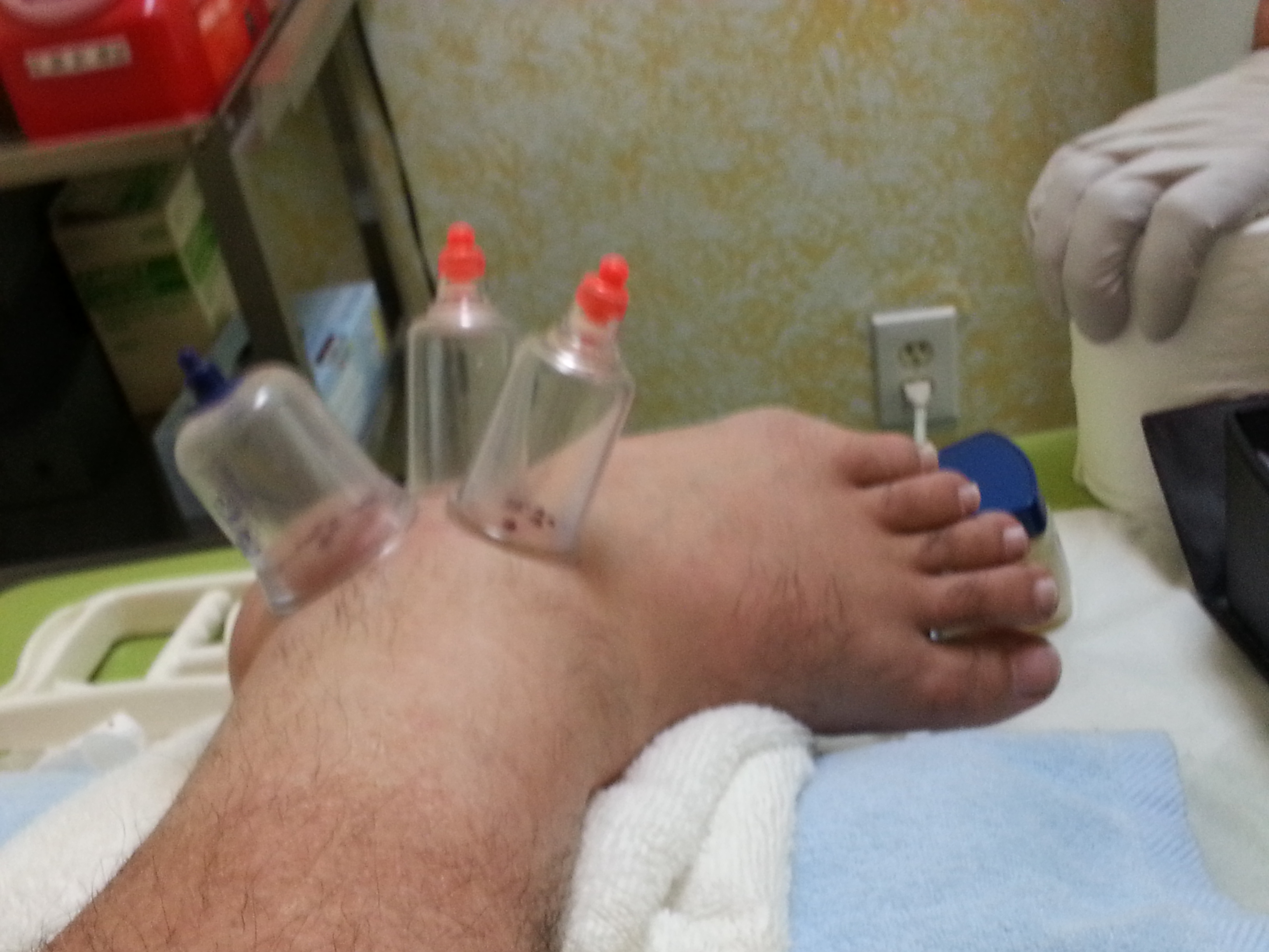 Bleeding and Cupping